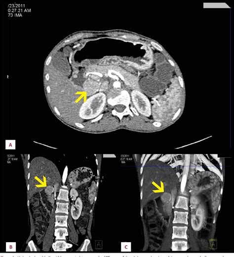 Figure 2 from Zollinger-Ellison Syndrome Associated with von Recklinghausen Disease: Case Report ...