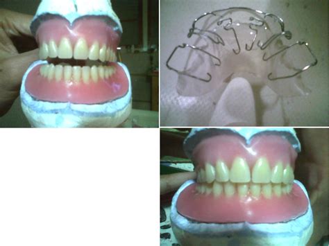 Free photo: Dental prosthesis - Dental, Teeth - Free Download - Jooinn