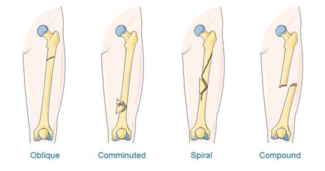 Open Fracture Treatment | Open Bone Fracture Surgery