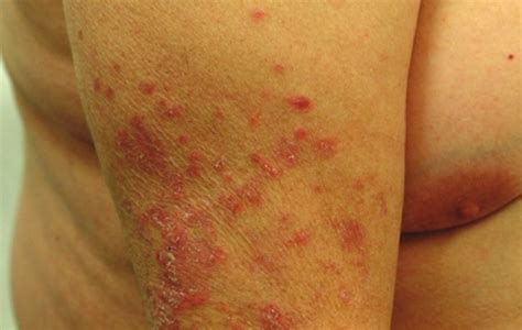 What Does Lupus Rash Look Like On Legs - Infoupdate.org