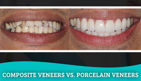 Composite Veneers Vs. Porcelain Veneers