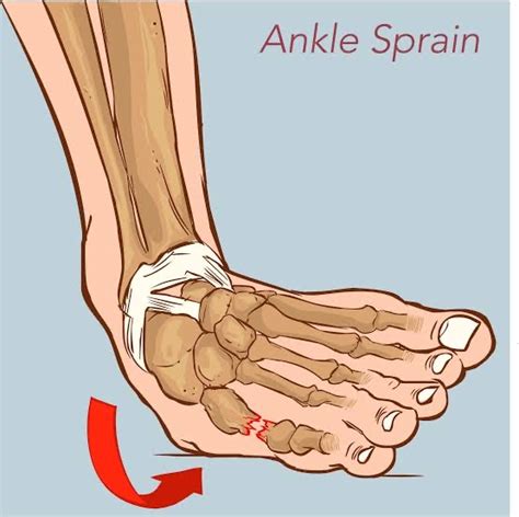 Ankle Sprain - Wellness Clinic