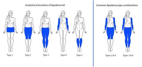 [Figure, Lipedema Types Contributed by Vyas et al] - StatPearls - NCBI Bookshelf