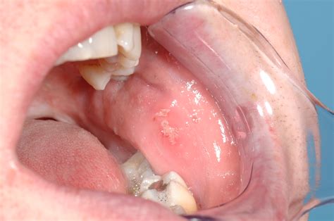 Oral mucosal lesions