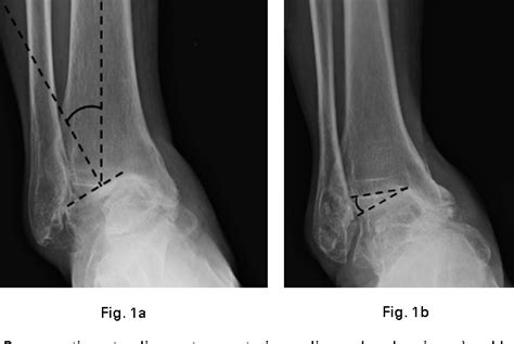 varus deformity | Semantic Scholar