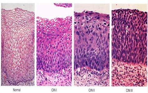 Cancer, cervix. Causes, symptoms, treatment Cancer, cervix