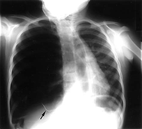 Tension Pneumothorax Tracheal Deviation