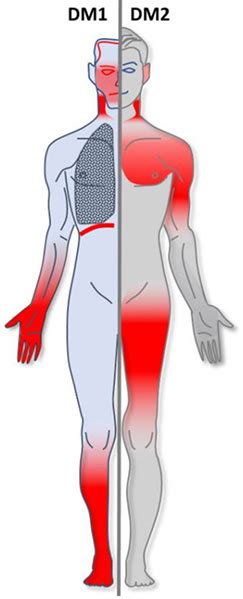 Medicine:Myotonic dystrophy - HandWiki