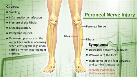 43 best images about Foot Drop on Pinterest | Neuropathic pain, Freedom ...