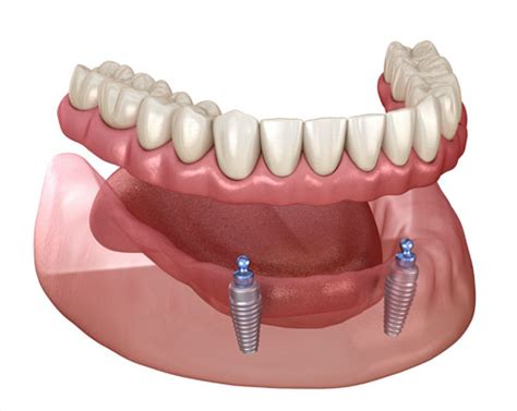 Comparing Conventional Dentures with Implant-Supported Dentures