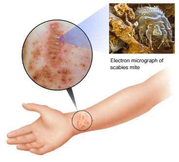 Scabies - symptoms, causes, diagnosis, Scabies treatment