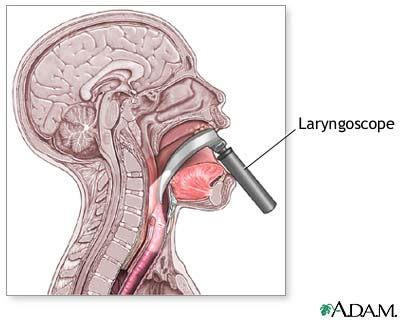 Laryngoscope. Causes, symptoms, treatment Laryngoscope