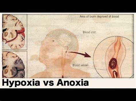 What is the difference between hypoxia and anoxia? - YouTube