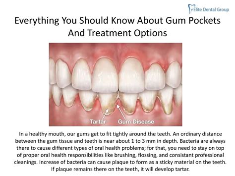 PPT - Everything You Should Know About Gum Pockets And Treatment Options PowerPoint Presentation ...