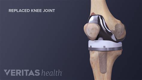 Types of Knee Surgery for Arthritis Treatment