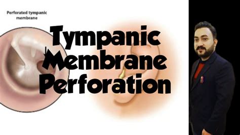 Tympanic Membrane Perforation - YouTube