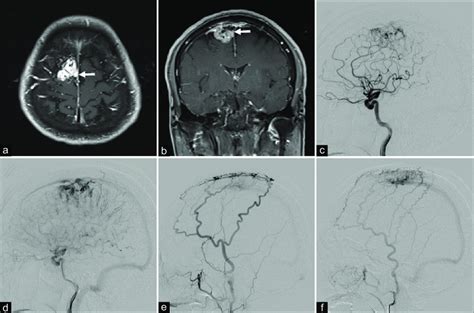 Parasagittal meningioma. Axial (a) and coronal (b) T1-weighted magnetic... | Download Scientific ...