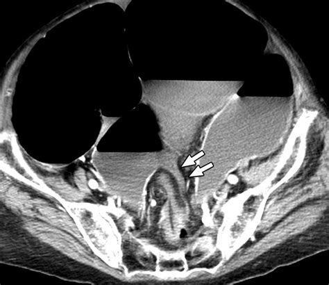 CT Findings of Sigmoid Volvulus | AJR