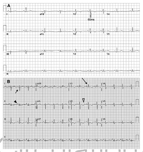 ECGs in patients with right-sided heart disease. A, ECG from a patient... | Download Scientific ...