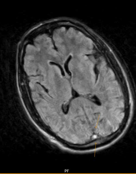 Superior Sagittal Thrombosis-MRI - Sumer's Radiology Blog