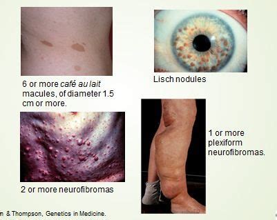 Neurocutaneous Disorders Flashcards | Quizlet