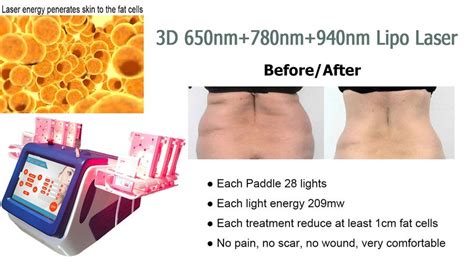 Laser Lipo vs. CoolSculpting - Beijing Starlight S&T Development