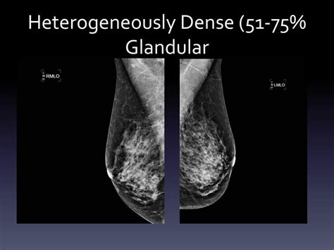 PPT - Breast Cancer Screening What’s New to Know? The Issue of Breast ...