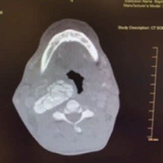 Coronal view, CT soft tissue neck. An amorphous calcified soft tissue ...