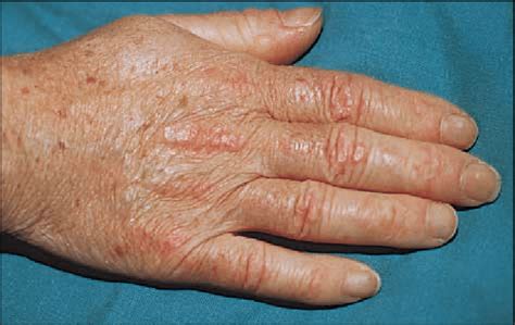 Gottron sign: symmetric violaceous erythema overlying the dorsal aspect... | Download Scientific ...