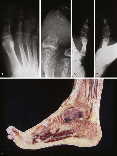 Metastatic Tumors in Bone | Basicmedical Key