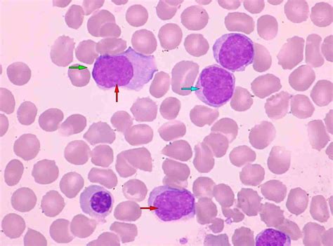 Mantle cell lymphoma symptoms, diagnosis, prognosis and treatment