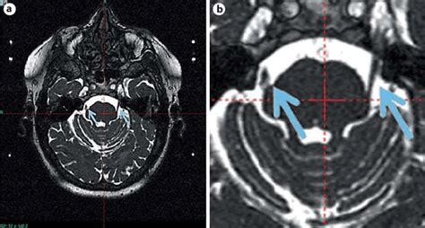 View 17 Trigeminal Nerve Mri Planning - drawdoorbox