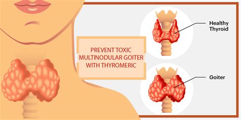 Study proves Curcumin can Help in Toxic Multinodular Goiter