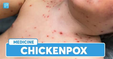 Chickenpox: Causes, Stages, Symptoms and Risk Factors