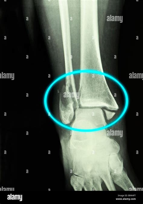 Bimalleolar fracture treatment - statvalue