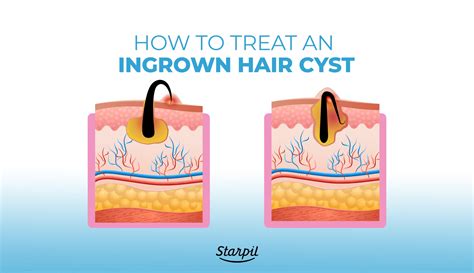 Ingrown Hair Cysts: Treatments, Causes & Symptoms | Starpil Wax