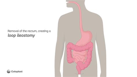 Creation of loop ileostomy by removing the rectum | Ostomy surgery ...