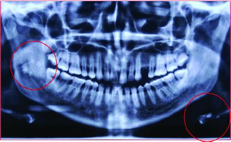 OPG showing multiple radiopaque discrete calcifications with lamination... | Download Scientific ...