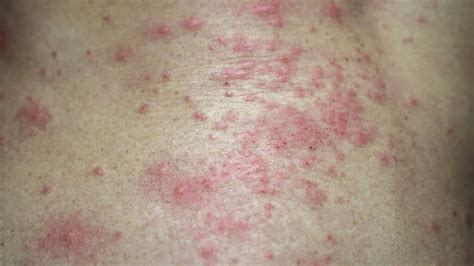 Bacterial Skin Rash - Causes, Remedies, And Treatments Revealed!