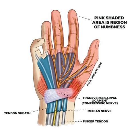 Pregnancy Related Carpal Tunnel Syndrome – Why does it happen & what can we do to help? | All ...