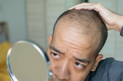 What Vitamin Deficiency Causes Hair Loss In Men - Infoupdate.org