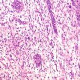 Histopathology of cutaneous carcinosarcoma (sarcomatoid carcinoma) of ...