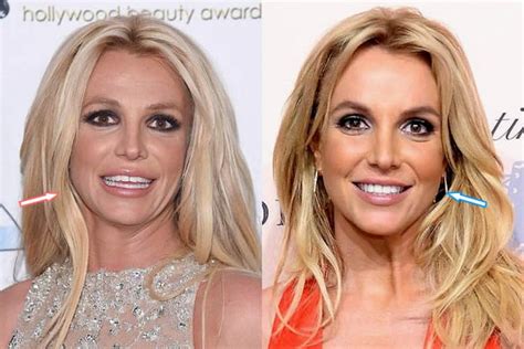 Did Britney Spears Have Cosmetic Surgery? (Before & After 2018)