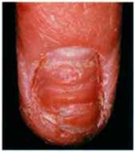 Transverse Lines - Nail Disorders - RR School Of Nursing