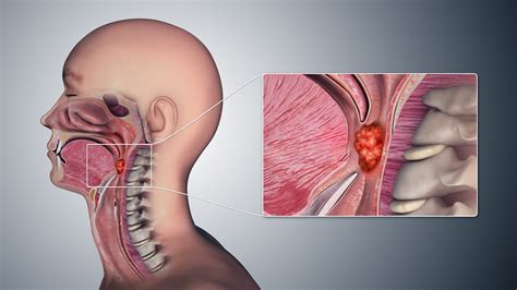 Throat Cancer: Early Signs, Symptoms, Causes, and Prognosis - Remedies Lore