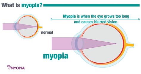 Myopia Control Global Eyecare Optometry