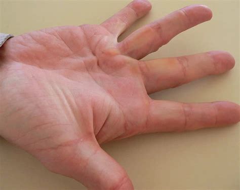 palmar erythema causes - pictures, photos