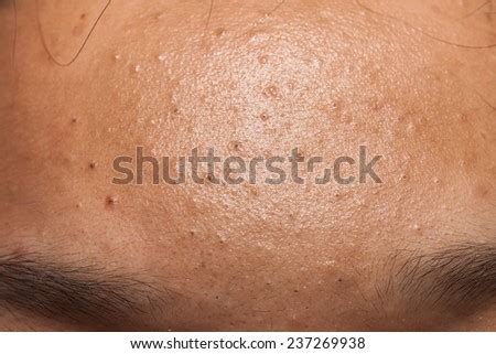 Pimple Blackheads On Forehead Teenager Stock Photo (Edit Now) 237269938 - Shutterstock