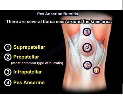 Pes Anserine Bursitis Anatomy