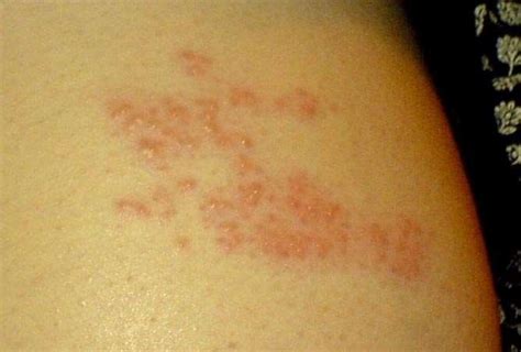 Do I Have Shingles? Symptoms, Causes and Natural Remedies for Shingles (Herpes Zoster Virus ...